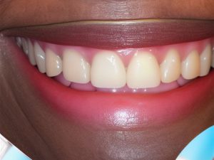 Efekty leczenia ortodontycznego po 8 miesiącach